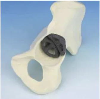 Fig. 1 – Trabecular metal wedge positioned in acetabular defect. 9