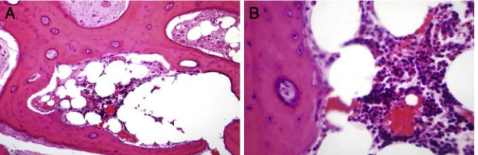 Fig. 4 – Histological study on bone biopsy from the left femur, in hematoxylin-eosin (A) and (B), showing infection and chronic inflammation marked by fibrosis, xanthogranulomatous reaction and foci of suppuration indicative of GSO.