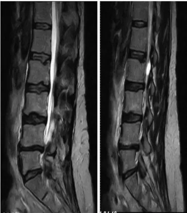 Fig. 1 – MRI of the lumbar spine (sagittal slice), in which lumbar stenosis can be seen at L2–S1.