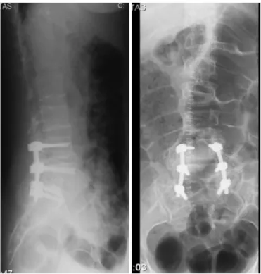 Fig. 3 – X-ray of the lumbar spine after surgery with arthrodesis at L4–S1.