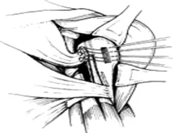Fig. 1 – Original technique of Dickson and O’Dell (transfer of the pectoralis minor from the coracoid process to the greater tuberosity).