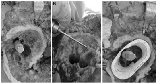 Fig. 1 – Tibial defect (A), debridement using a burring drill bit (B), tantalum cone test (C).