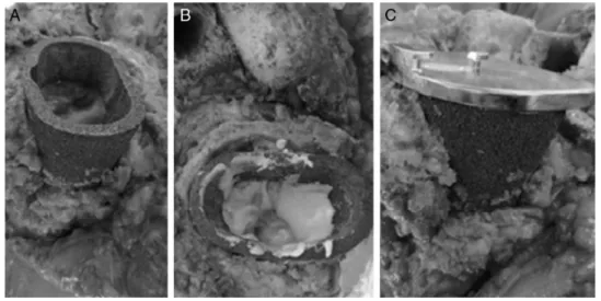 Fig. 2 – Tantalum cone in proximal tibia with autologous graft on external surface (A), cementation in interior (B), with implantation of the tibial component (C).