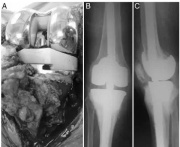 Fig. 3 – Final implant with tantalum cone (A), postoperative X-rays (B and C).