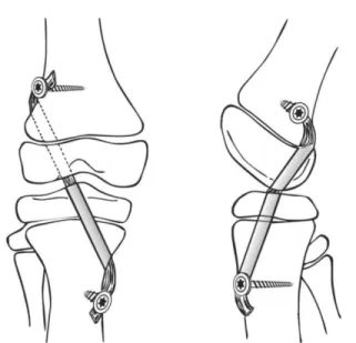 Fig. 3 – Illustration demonstrating the partial transphyseal (PTP) technique for ACL reconstruction.