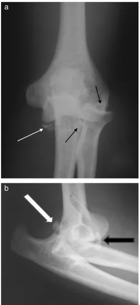 Fig. 1 – Anteroposterior (AP) radiograph of a dislocated left elbow (case 10). White arrow, fragment of the fracture of the coronoid process
