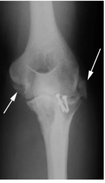 Fig. 4 – Anteroposterior (AP) radiograph of the left elbow (case 10), seven months after the operation