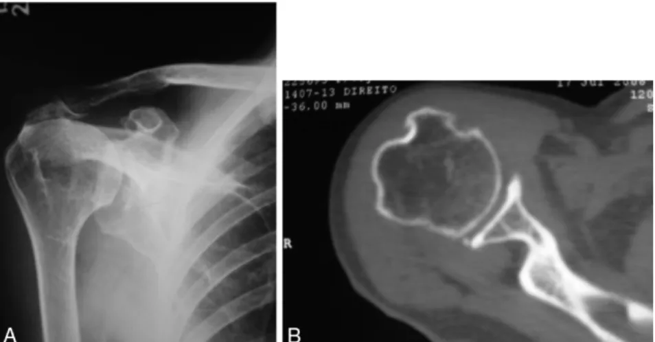 Fig. 5 – (A and B) Preoperative imaging examinations. Clinical case 2: 79-year-old female patient presenting pain and limitations for six years, with pseudoparalysis.