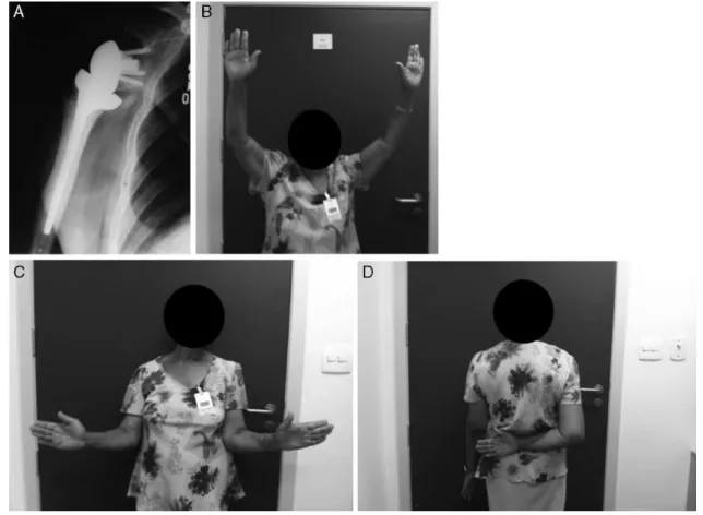 Fig. 6 – (A–D) Postoperative imaging examination and clinical result.