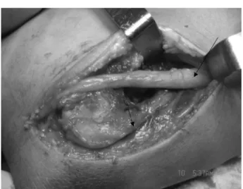 Fig. 1 – Decompression and transposition of the ulnar nerve in the elbow. Large arrow: ulnar nerve; small arrow: