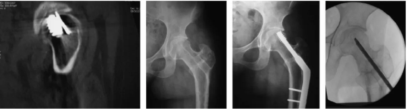 Fig. 2 – Example of a broken guidewire. Arthroscopy can be used to remove the wire.