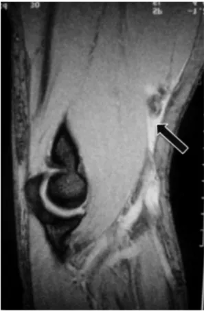 Fig. 2 – MRI of the elbow (sagittal slice), showing tear (arrow) with retraction of the insertion of the tendon of the biceps muscle.