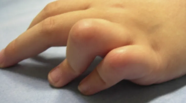 Fig. 1 – Camptodactyly in the ring and little fingers.