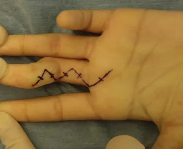 Fig. 10 – Release of volar structures.