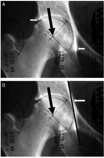 Fig. 2 – (A) Reference lines H, V1 and V2. The center of rotation is marked on the normal side, indicated by an arrow