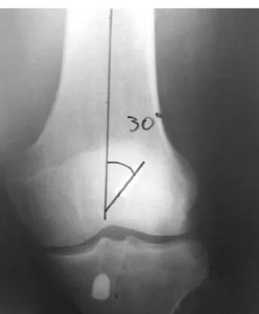 Fig. 1 – The posteriorization of the interference screw (measurement P) was measured by dividing the distance between points 1 and 2 (posterior cortical bone to the center of the screw) by the distance between 1 and 3 (center of the screw to the anterior c