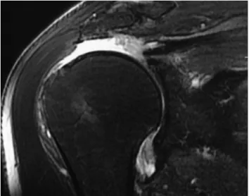 Fig. 1 – Magnetic resonance image (coronal slice) of the right shoulder showing extensive injury to the rotator cuff.