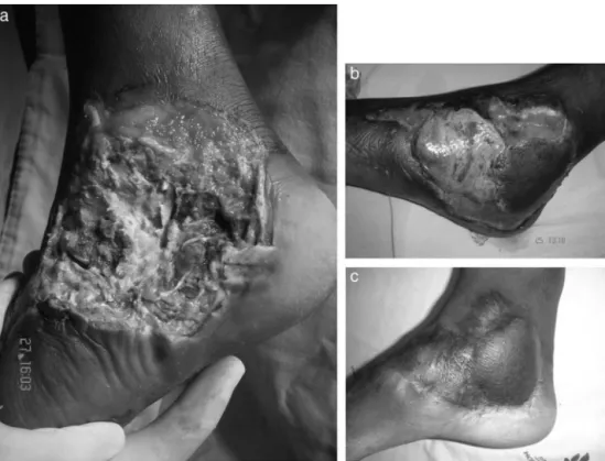 Fig. 4 – Case 3, right foot: sural and lateral supramalleolar flaps. (a) Loss of skin tissue with bone exposure in the midfoot and hindfoot and part of the ankle, secondary to burns after an accident involving a motorcycle exhaust; (b) sural flap integrate