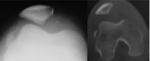 Fig. 1 – Preoperative evaluation of the right knee.