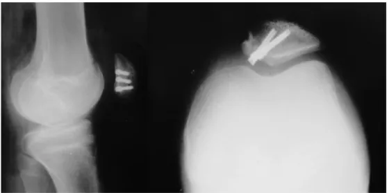 Fig. 3 – Postoperative radiography of the right knee.