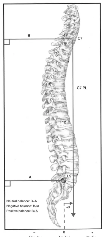 Fig. 3 – (A) Sacral tilt (SS) is defined as the intersection of the horizontal reference line (HRL) and the sacral endplate (b–c)