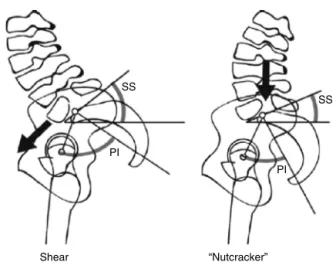 Fig. 5 – The posture in shear and in “nutcracker”, published by Roussouly et al. 14 for low-grade spondylolistheses.