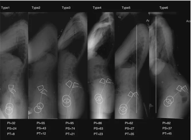 Fig. 9 – Classification of the Spinal Deformity Study Group. PI = pelvic incidence, SS = sacral slope, PT = pelvic tilt.
