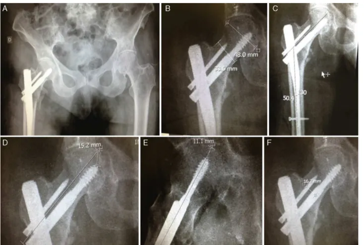 Fig. 4 – Use of Impax ® for the taking of measures. (A) AP radiograph of the pelvis, as described