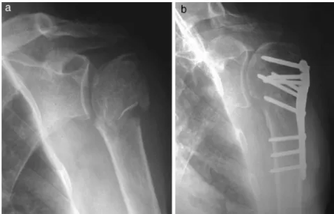 Fig. 1 – Case 5: Radiographs of left shoulder (frontal view), showing a three-part fracture with epiphyseal trait; (a) preoperative, (b) postoperative, 29 months.
