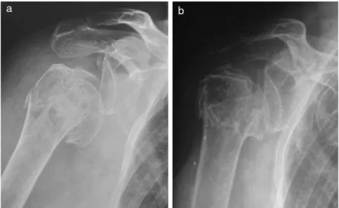 Fig. 2 – Case 3: Radiographs of the right shoulder (frontal view), showing a three-part fracture with epiphyseal trait; (a) preoperative, (b) postoperative, 17 months.