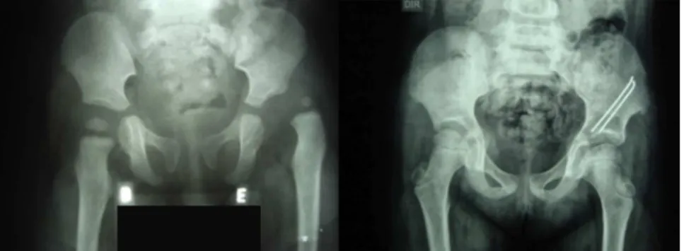 Fig. 2 – Radiological evolution of a female patient with DDH treated with Salter et al.’s osteotomy