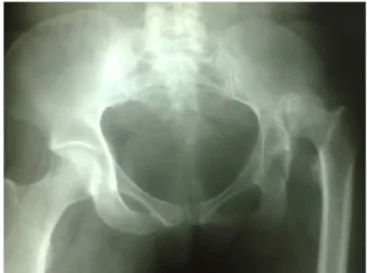 Fig. 1 – Radiography of pelvis in the anteroposterior view in the preoperative planning that highlights the