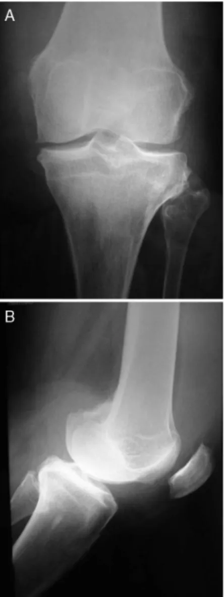 Fig. 1 – Increased volume in the left knee.