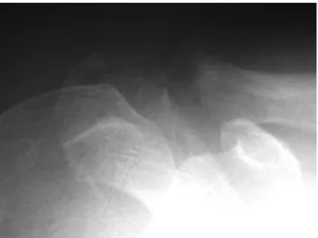 Fig. 1 – Radiograph of the right shoulder, Zanca view, showing arthrosis of acromioclavicular joint.