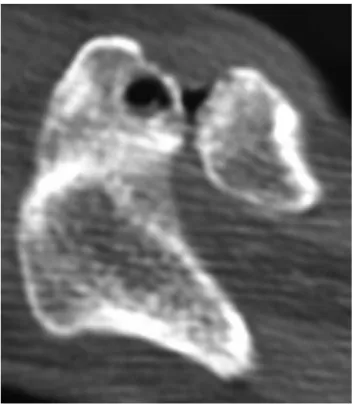 Fig. 3 – Axial CT image of the right shoulder showing osteoid osteoma in the acromion, next to the