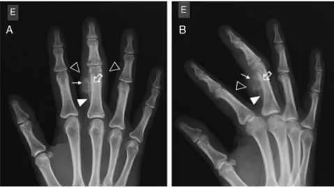 Fig. 1 – RX AP (A) and oblique (B), showing ossification of soft tissues of the radial and flexor diaphyseal faces of the proximal phalanx of the third chirodactyl, with irregular and partially defined contours (arrows), cortical erosion (open arrows) and 