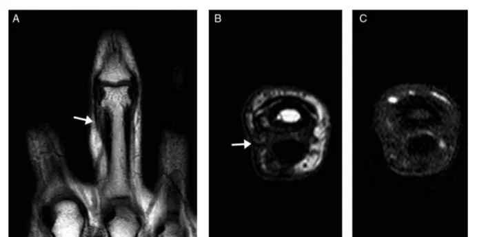Fig. 4 – Five months after surgery, MRI scan in the coronal and axial plans (A, B) demonstrating absence of nodulation, and fibrocicatricial change (arrows) in the soft tissues, and after the administration of paramagnetic contrast (C), without areas of si
