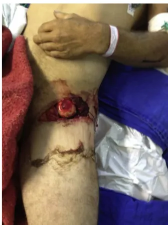 Fig. 1 – Appearance of wound at the root of the left thigh, exposing the femoral head.