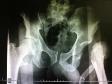 Fig. 3 – Postreduction radiograph showing left hip joint congruency.