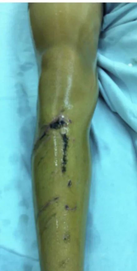 Fig. 8 – Image of extensive cutting-bruising wound and suturing in the anterior region of the lower leg.