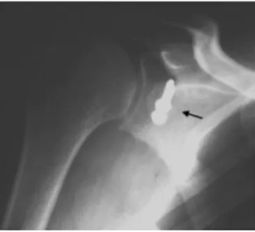 Fig. 1 – Radiograph of a shoulder in lateral scapular view showing breakage of synthesis material (arrow).