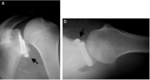 Fig. 6 – Radiographs of a left shoulder in (a) anteroposterior view and (b) axillary view, showing good positioning of the graft (arrows).