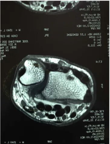 Fig. 2 – Comparison of the visual analog scale (VAS) variable from before to after the operation.