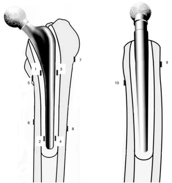 Fig. 3 – Strain gauges embedded in the cement mantle arranged from the tip of the nail (1, 2, 3, 4) and femoral gauges arranged from the end of the greater trochanter (5, 6, 7, 8, 9, 10)