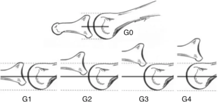 Fig. 1 – Hamilton–Thompson metatarsophalangeal “drawer test”: G0, stable joint; G1, mild instability