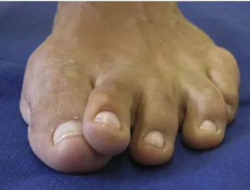 Fig. 4 – Different degrees of deformity of crossover toe.