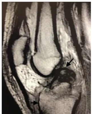 Fig. 1 – Preoperative radiography of the right knee (A) AP view and (B) profile view.