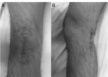 Fig. 4 – Surgical access routes in the late postoperative period of the right knee (A) anterior and (B) posteromedial.