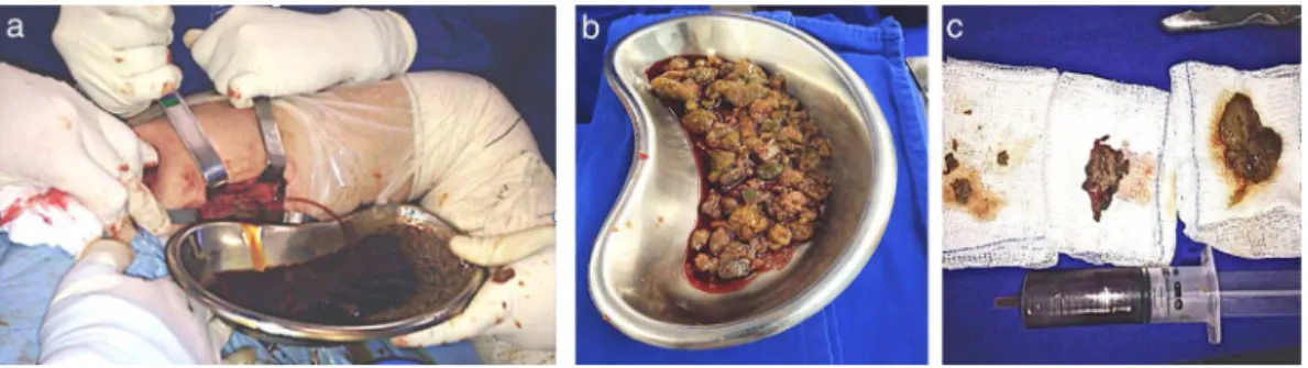 Fig. 4 – (a) Emptying of the pseudotumor showing large amounts of dark green fluid; (b) presence of lumps of the same color without characteristic odor and (c) approximated image of lumps and liquid contents in the syringe that was sent for laboratory anal