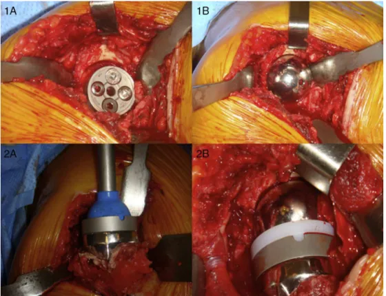 Fig. 1 – During the operation: (1A) insertion of baseplate with locking screws and cortical screws; (1B) fitting of glenosphere;